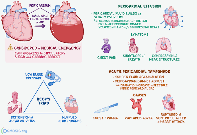 Cardiac tamponade treatment