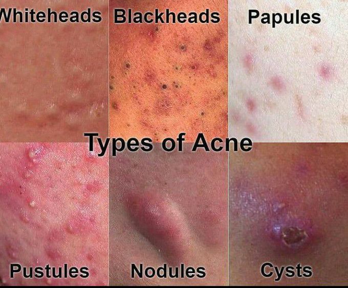 Types of acne