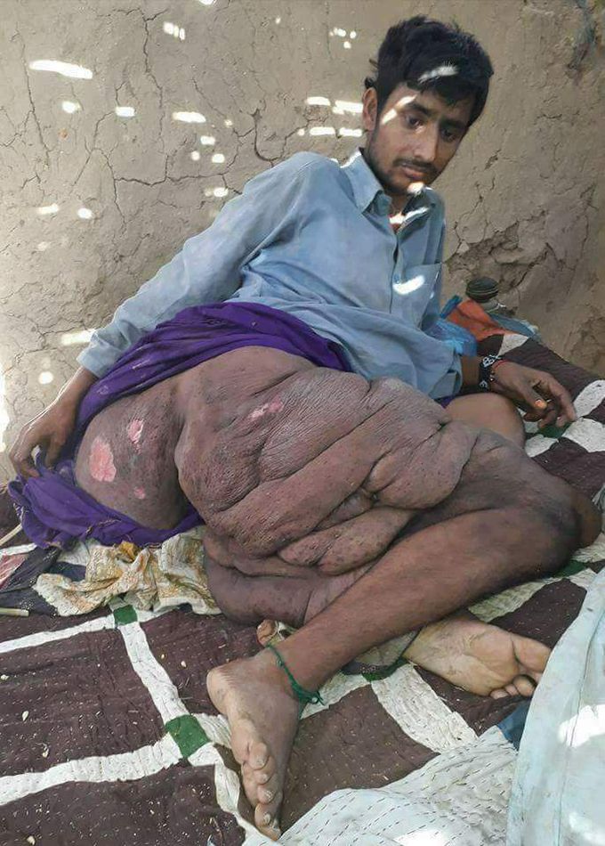what type of this disease.