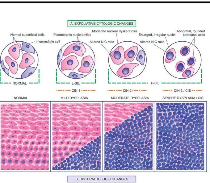 Cervical intraepithelial neoplasia (CIN) and squamous intraepithelial lesions (SIL).