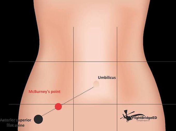 McBurney’s point