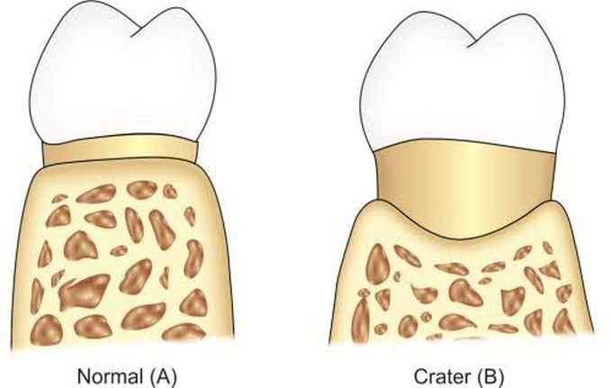 Osseous craters