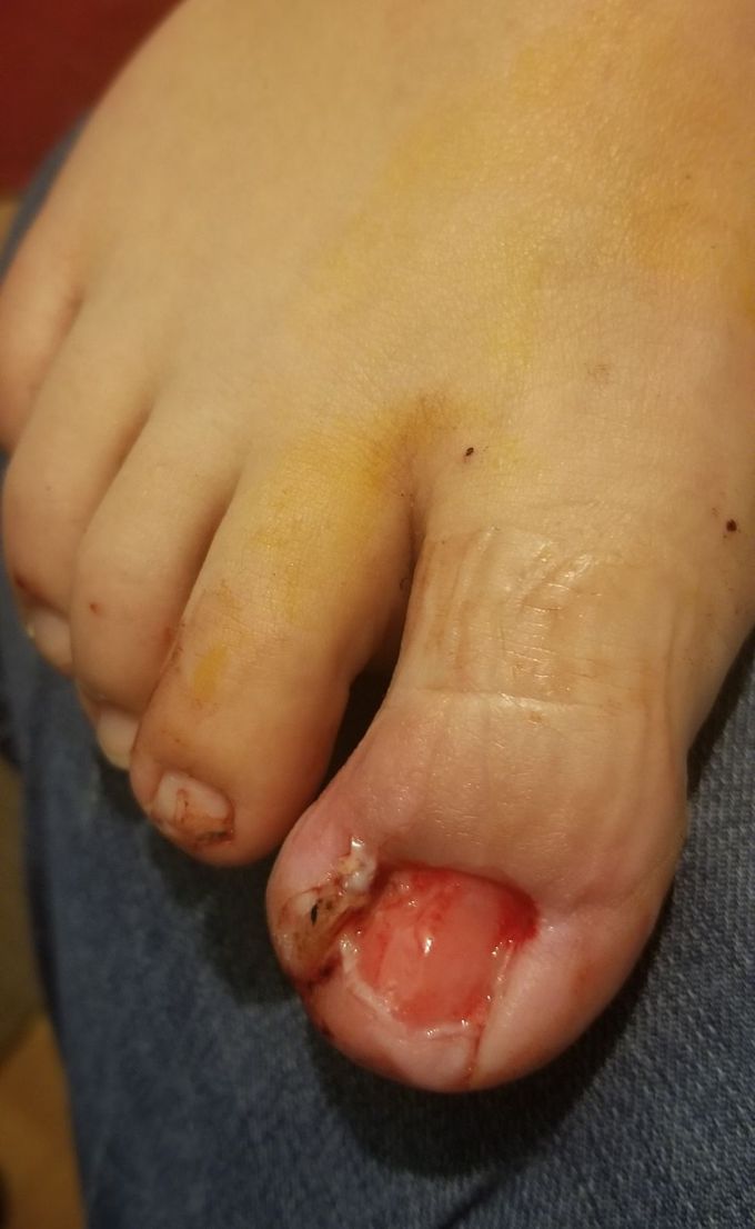 Infected toenail after its removal