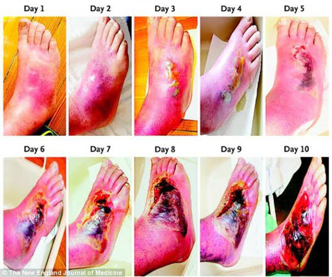 Diabetic Foot infection