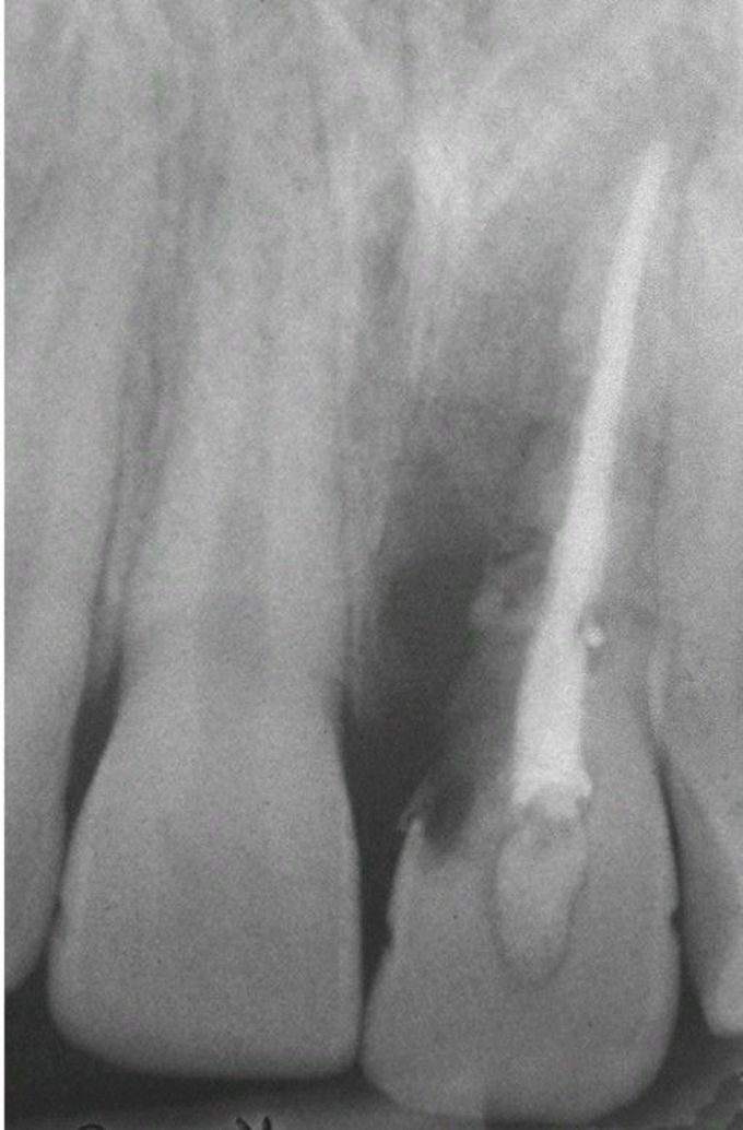 External resorption