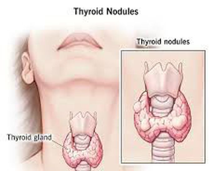 This is the representation of Thyroid Nodules
