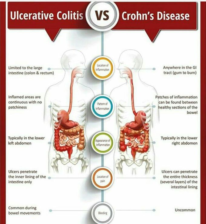 IBD