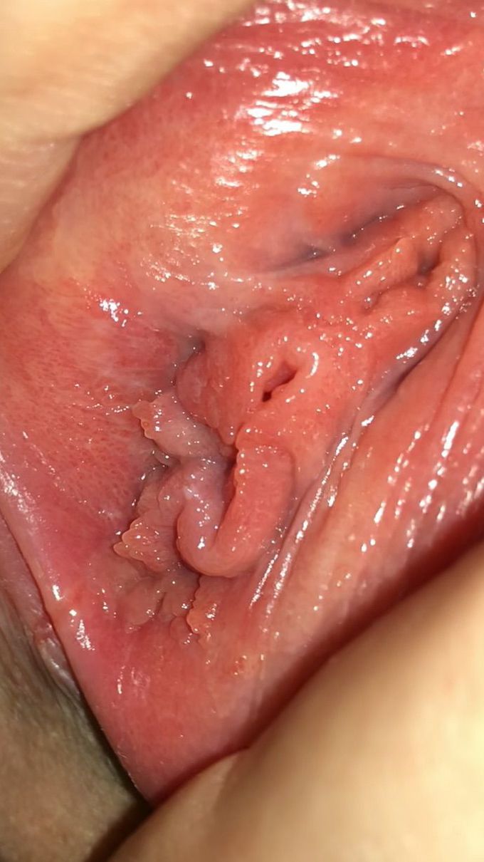 Suspicious warts