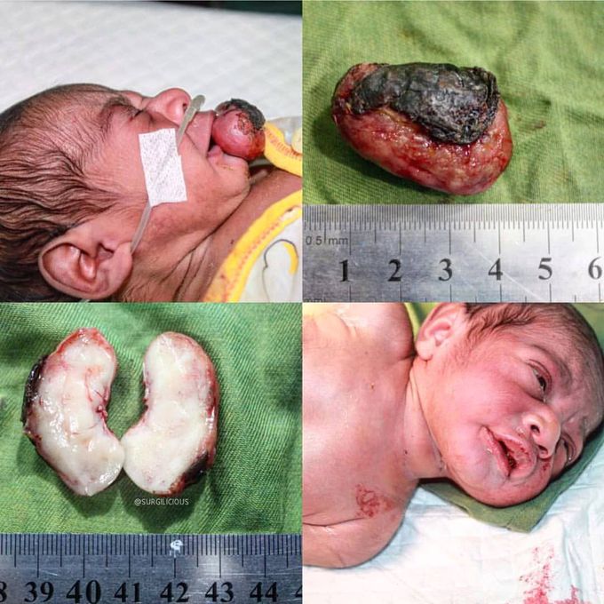 Congenital gingival granular cell tumor (CGCT)