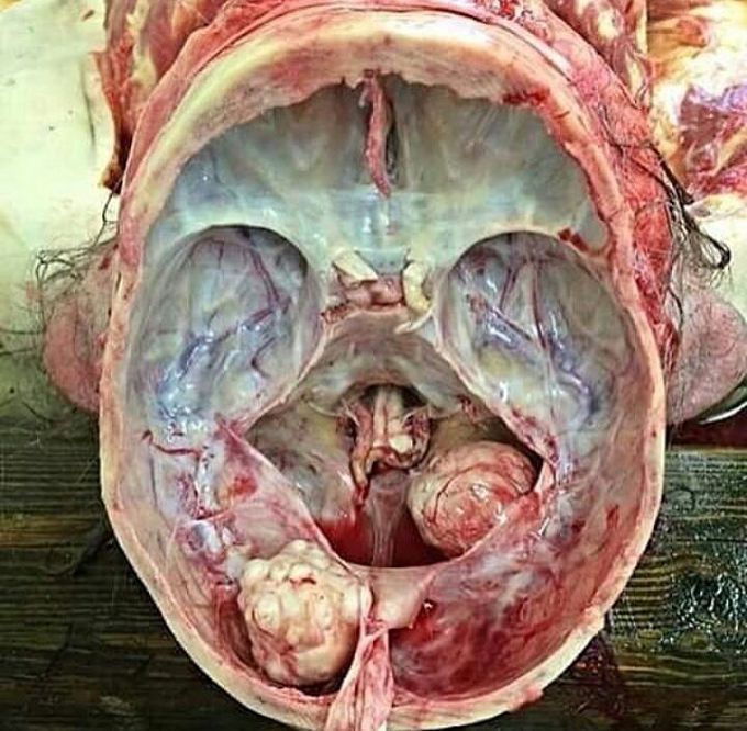 Skull Anatomy - Autopsy