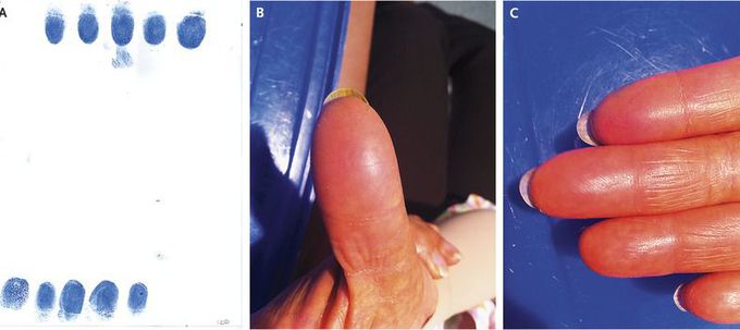 Loss of Fingerprints