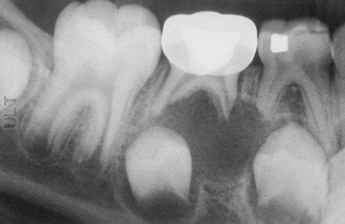 Periapical Cyst