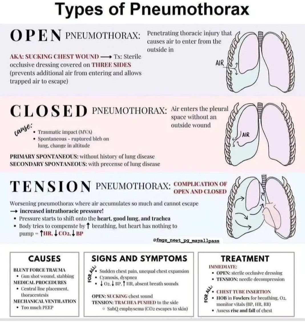 Types of Pneumothorax - MEDizzy