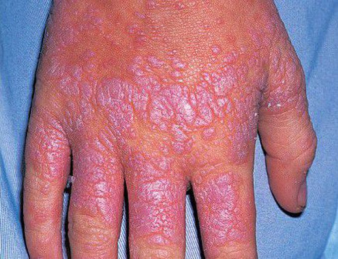 Lichen Planus