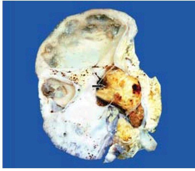 Staghorn renal stone