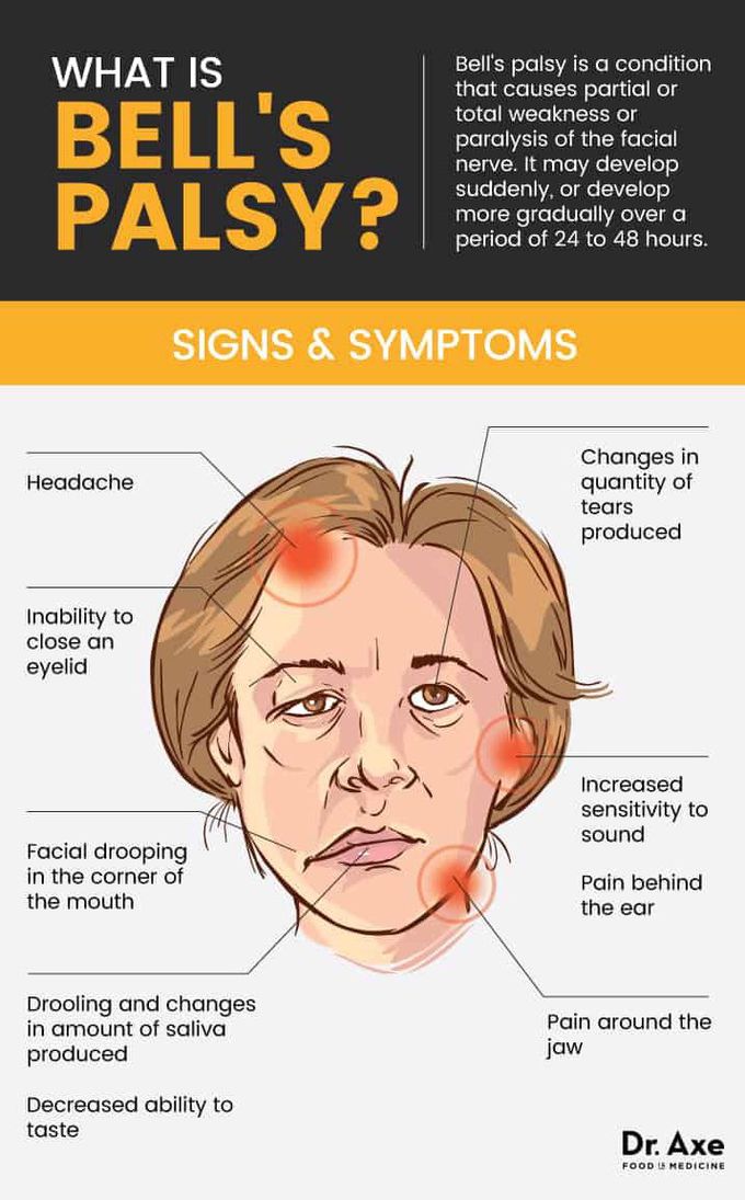 Bell's palsy