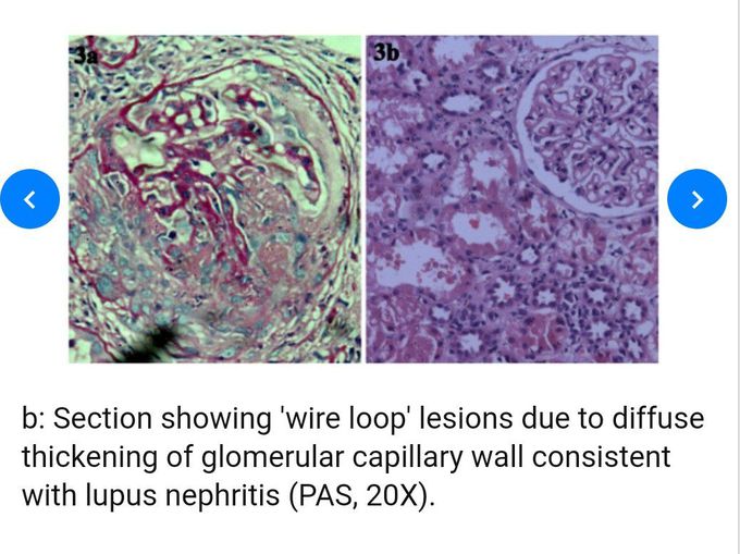 Lupus nephritis