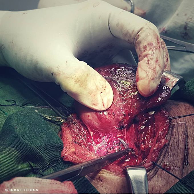 When the last time you saw the Reccurent laryngeal nerve (RLN) ? 