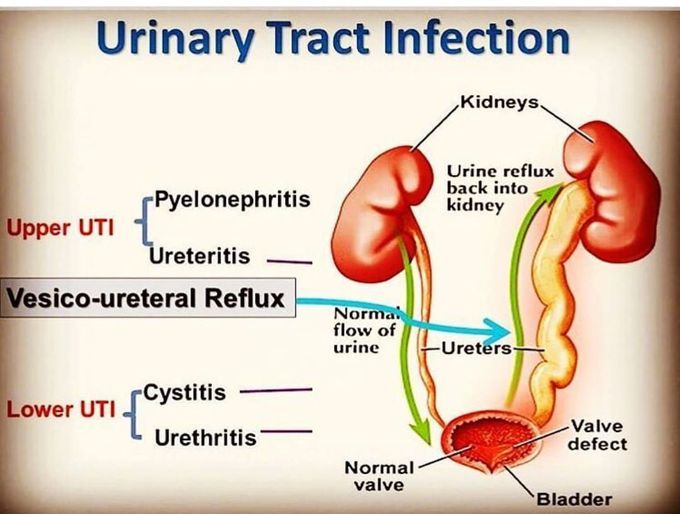 Urinary tract infection