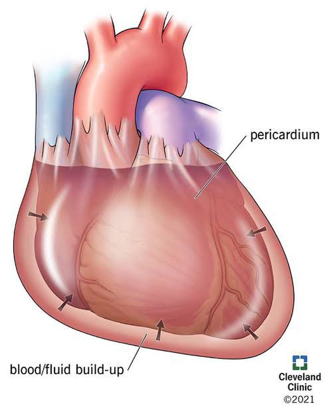 Cardiac tamponade