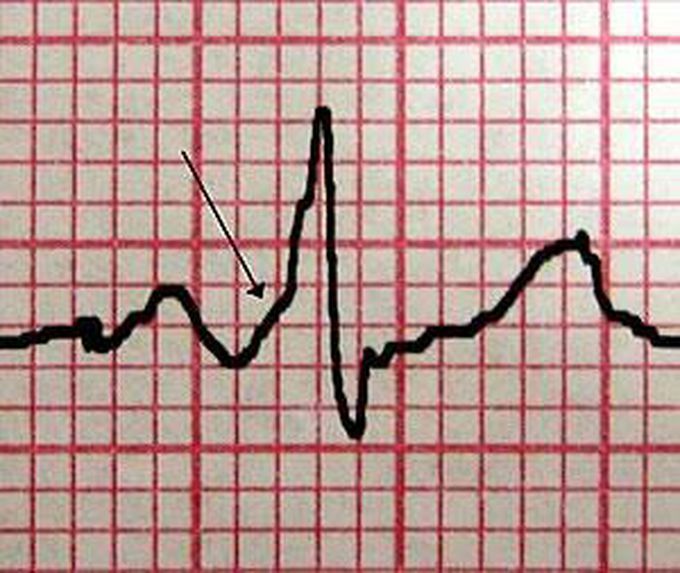 Wolff parkinson white syndrome