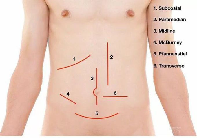 Incision body sites