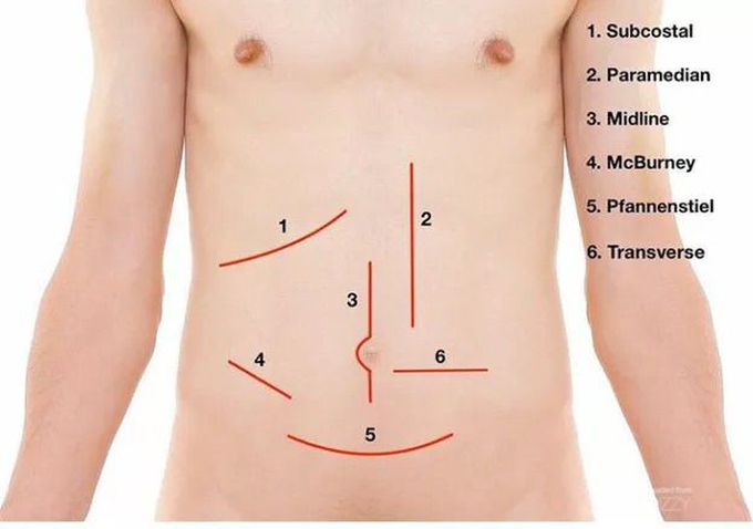 rocky davis incision