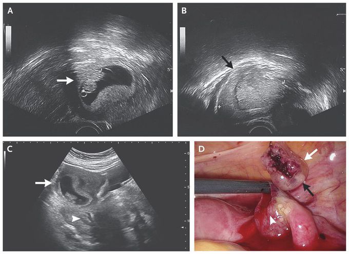 Heterotopic Pregnancy