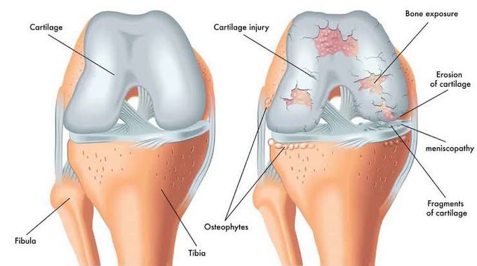 Crepitus