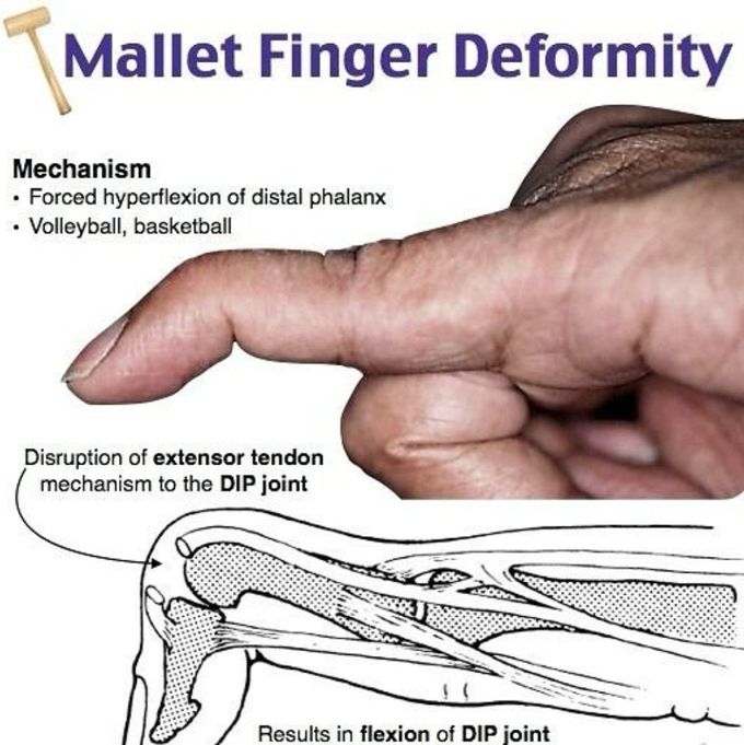 Mallet Finger Deformity