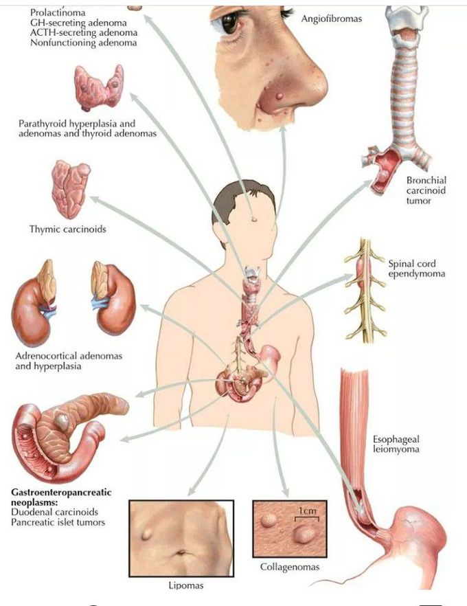 Multiple endocrine neoplasia type 1 (MEN-1)