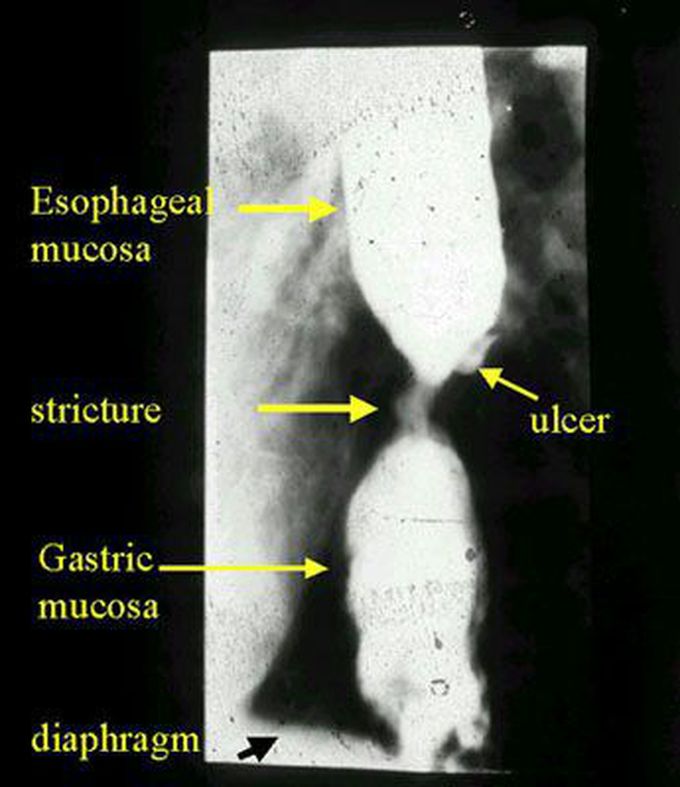 Barium study: Barrett's esophagus with stricture