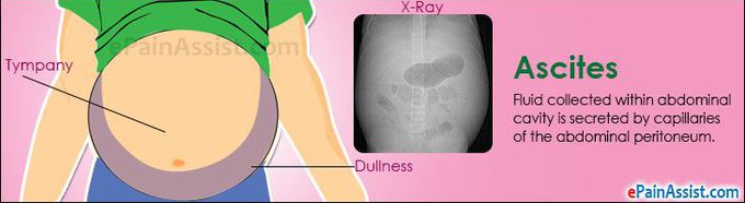 Ascites