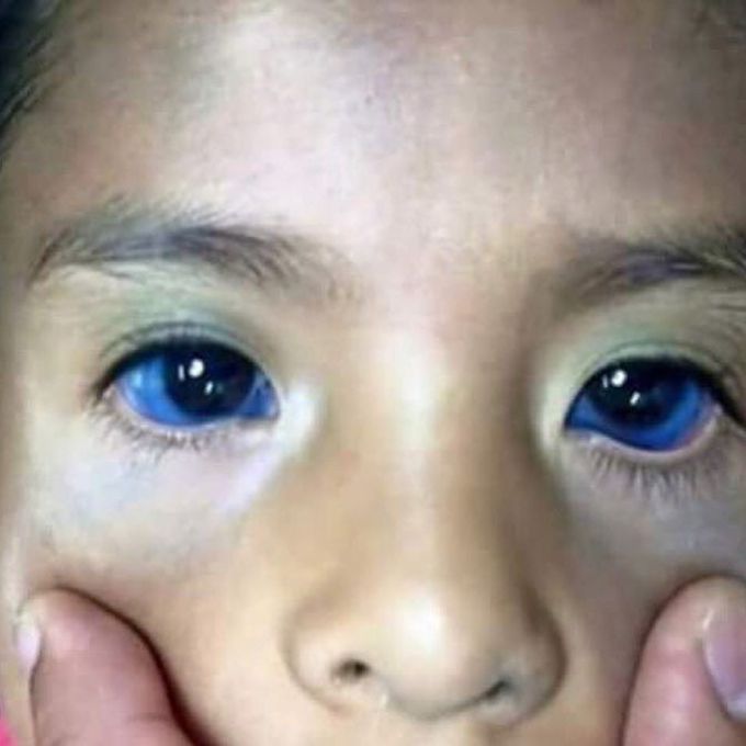 Osteogenesis Imperfecta Blue Sclera