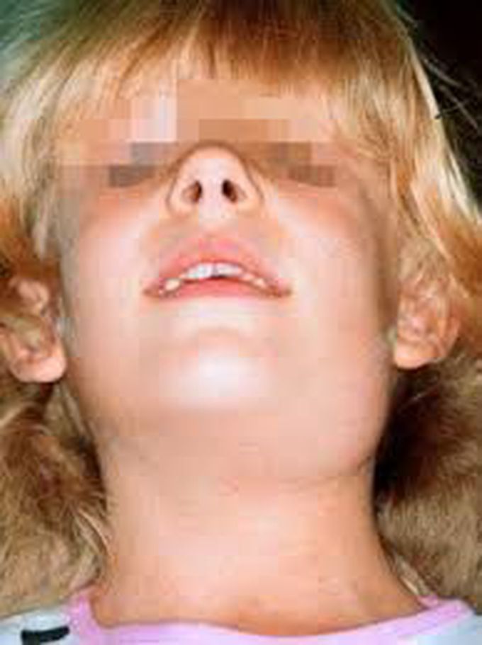 Causes of parotitis