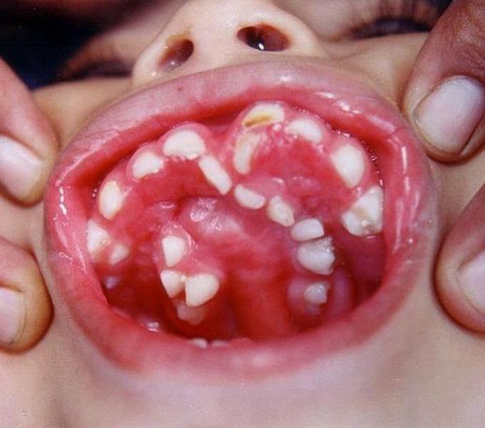 🦷🦷🦷 Hyperdontia 🦷🦷🦷