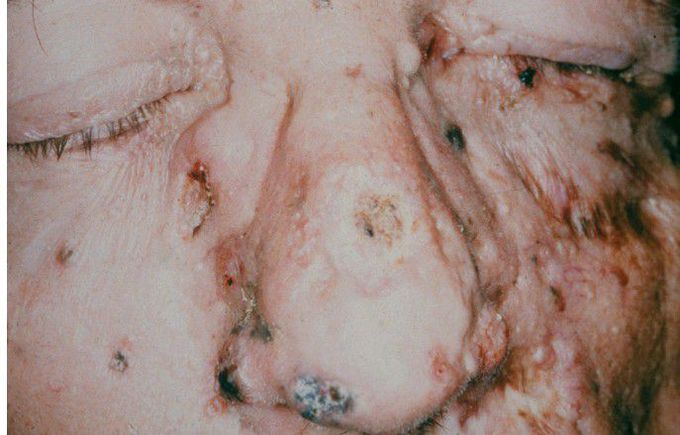 Nevoid Basal Cell Carcinoma Syndrome