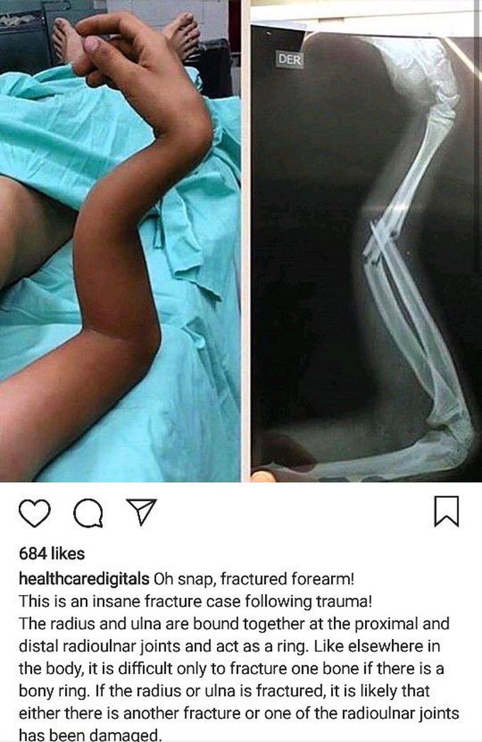 Hand fracture
