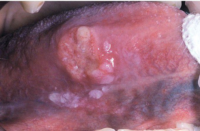 HIV-associated Squamous Cell Carcinoma.