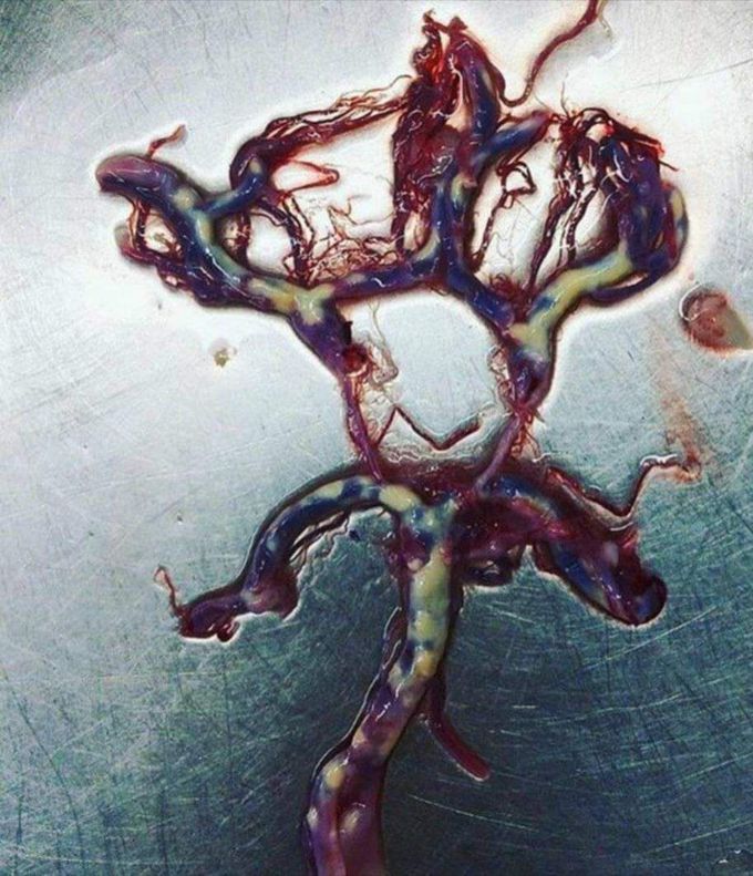 The Arterial Circle of Willis
