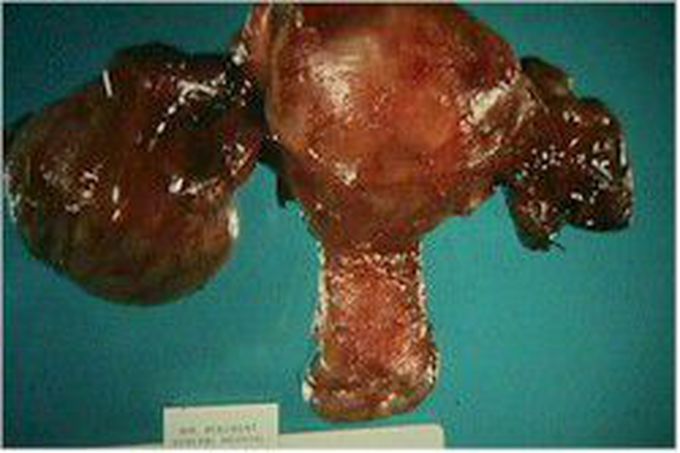 Chocolate cyst - The Ovary with Endometriosis