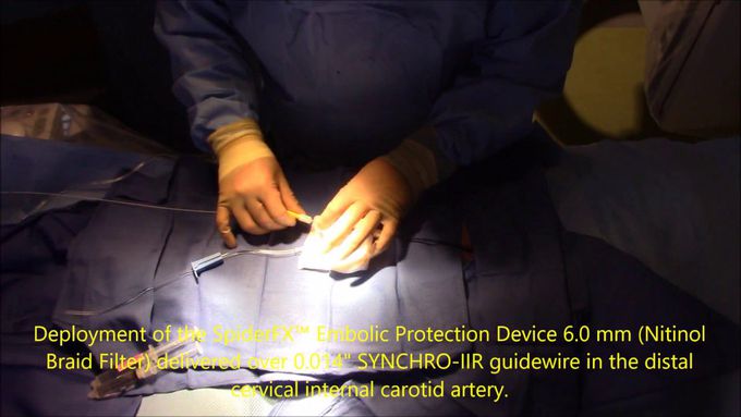 Left Internal Carotid Artery Angioplasty and Stent Placement