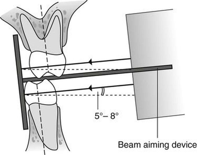 Bitewing radiograph technique