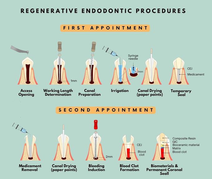 Regenerative Endodontic Therapy