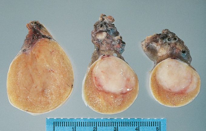 Testicular