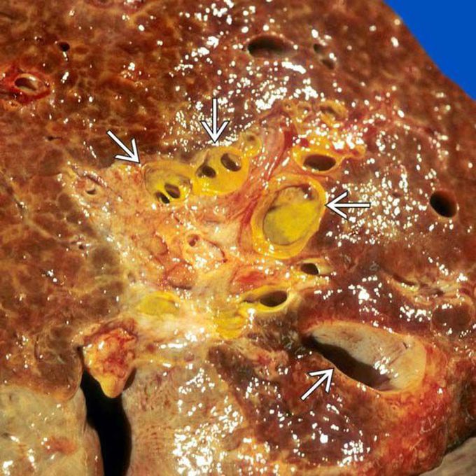 Caroli's Disease