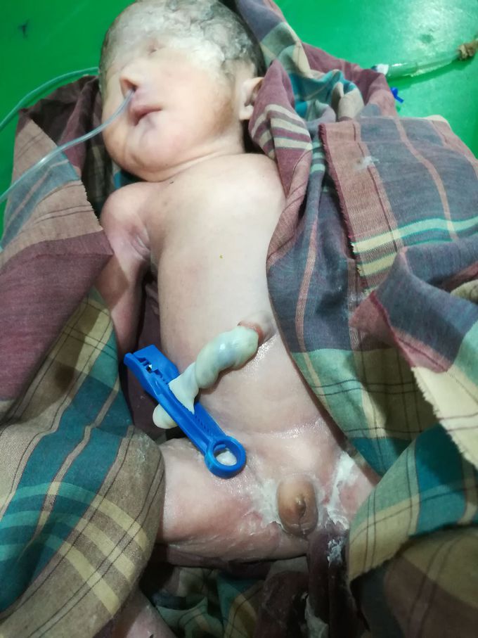 newborn born with anomalies