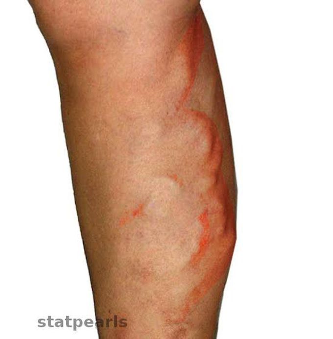 Thrombophlebitis