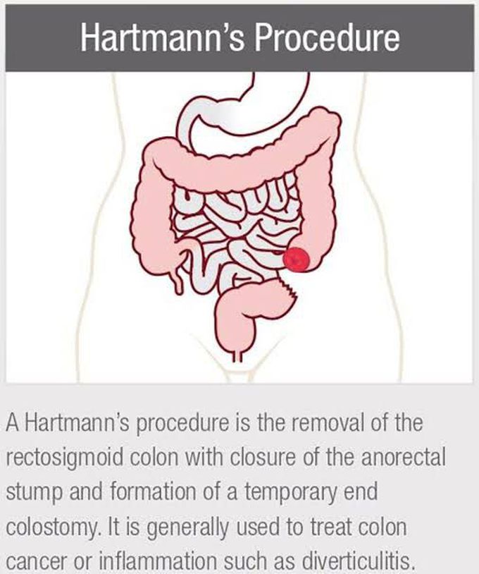 Hartman's Procedure