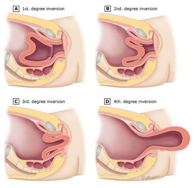 Uterine Inversion Grading